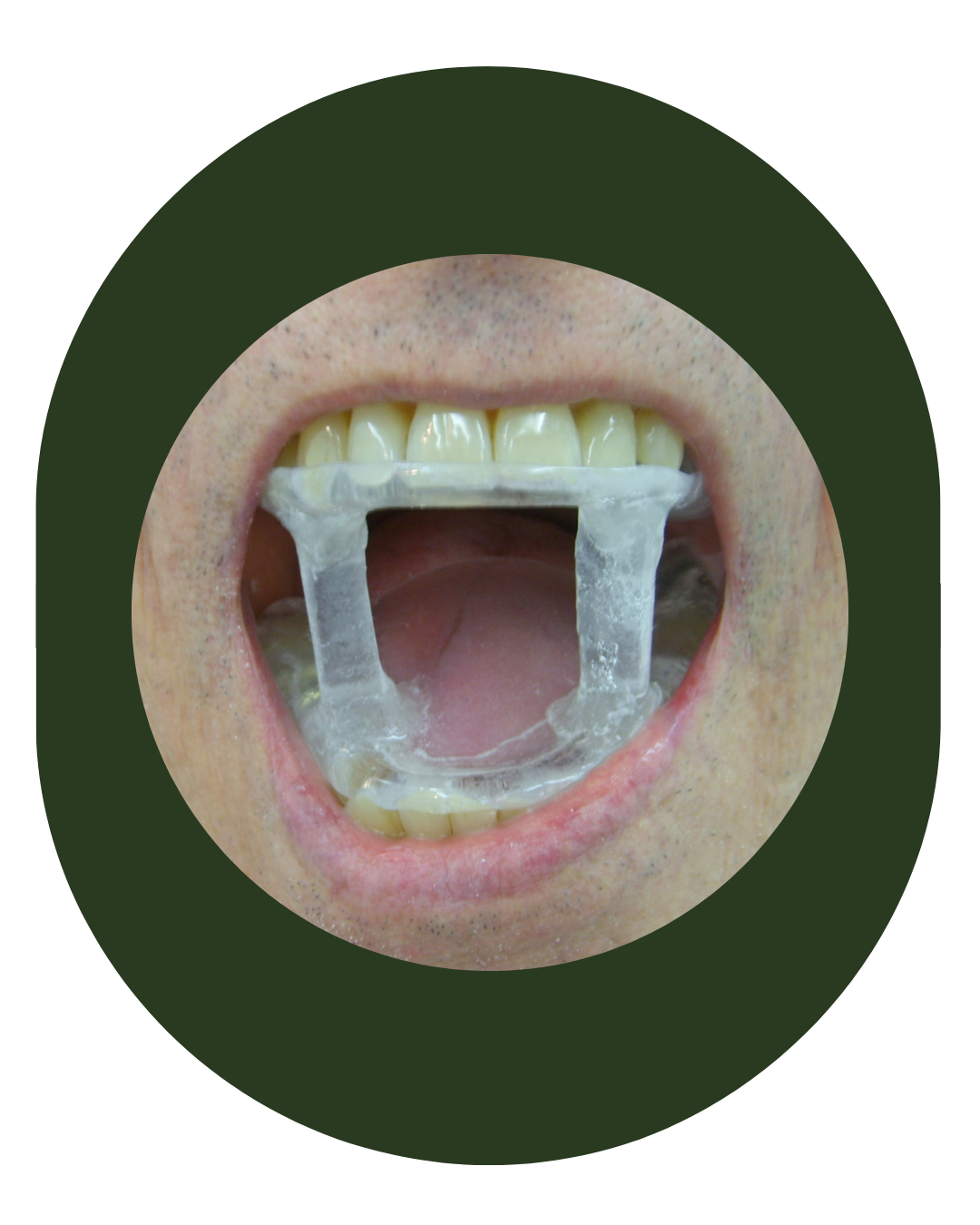 protese bucomaxilofacial, intra oral, Obturadora, Prótese para grandes perdas de maxila ou mandíbula, Rebaixadora de palato, Obturadora Imediata, Óculo Palpebral, Ocular, Nasal, Prótese de orelha, Prótese labial, Facial extensa, PROTETORES PARA RADIOTERAPIA